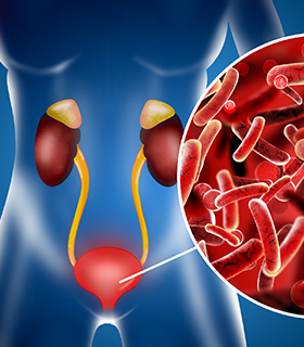 Urinary Tract Infection