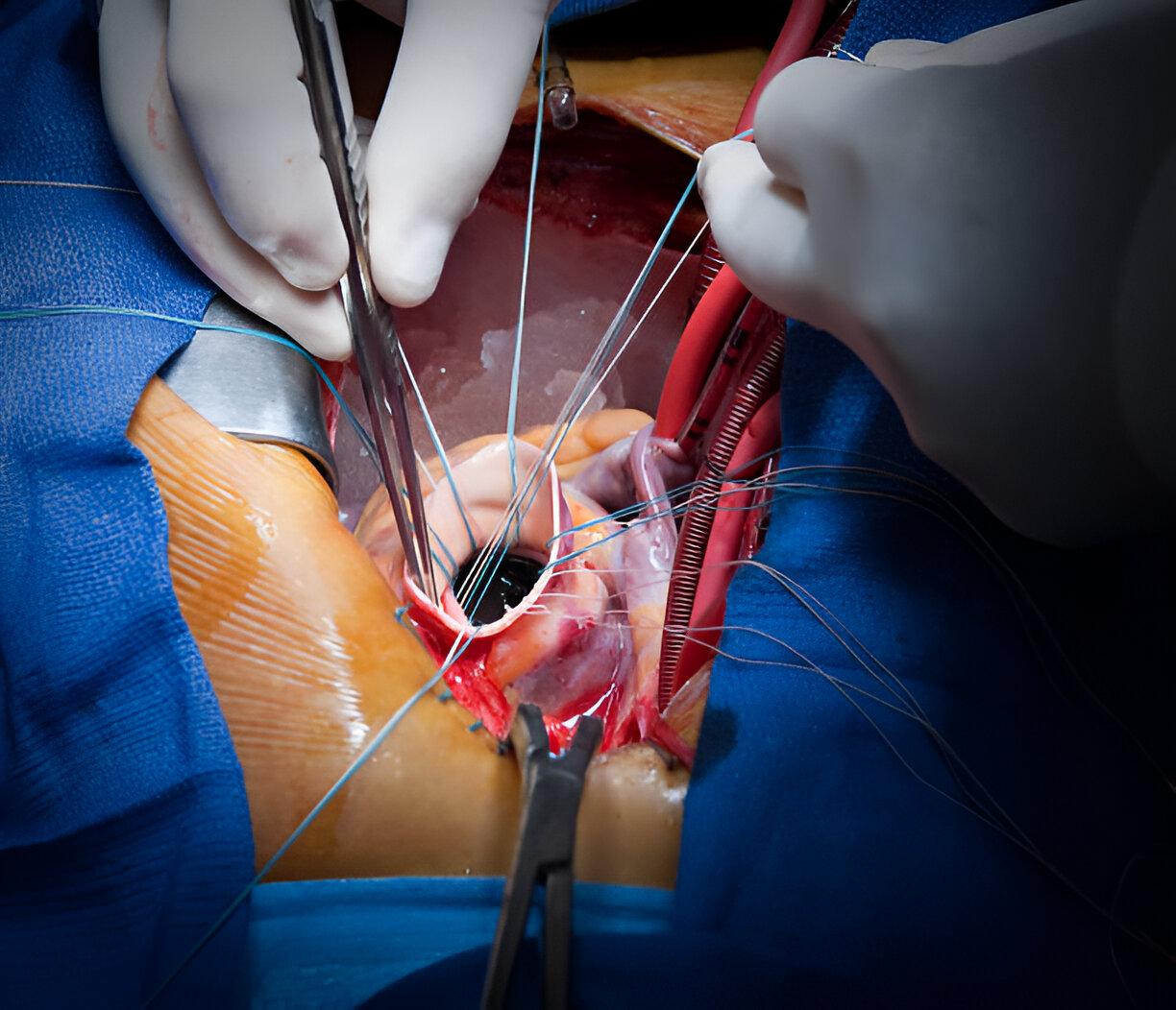 Aortic Valve Replacement surgery