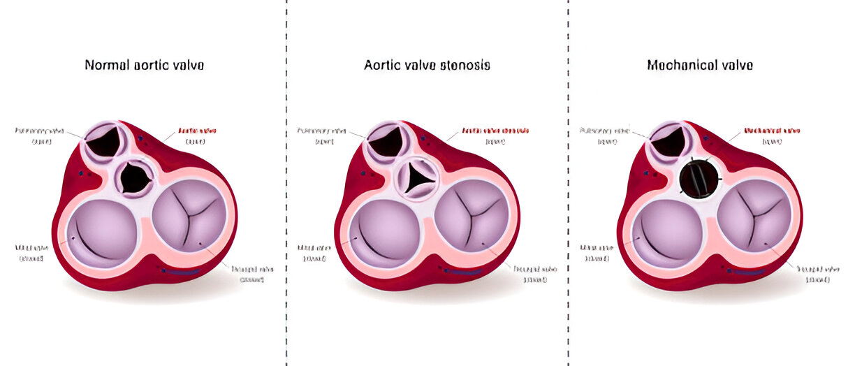 Diagram of Normal aortic valve, Aortic valve stenosis and Mechanical valve