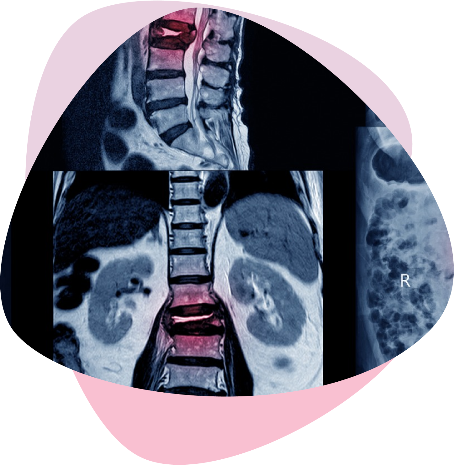 MRI of lumbar spine with back pain