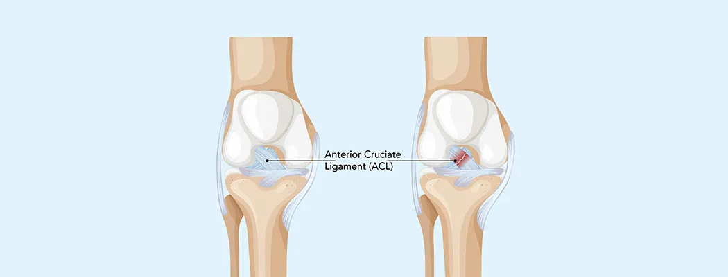 Illustration showing a healthy ACL and a torn ACL in the knee.