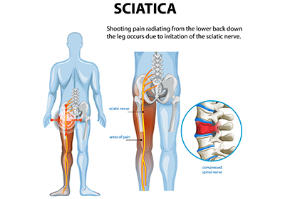 Sciatica vs Lower Back Pain: How to Identify the Difference