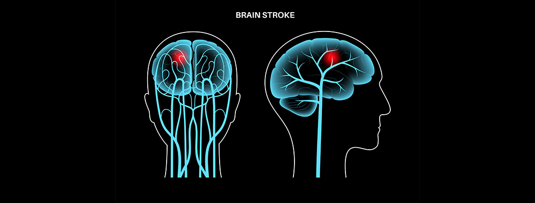 Why More Young Indians Are Having Strokes? 