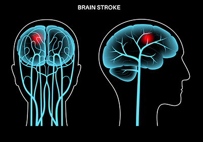 Why More Young Indians Are Having Strokes? 