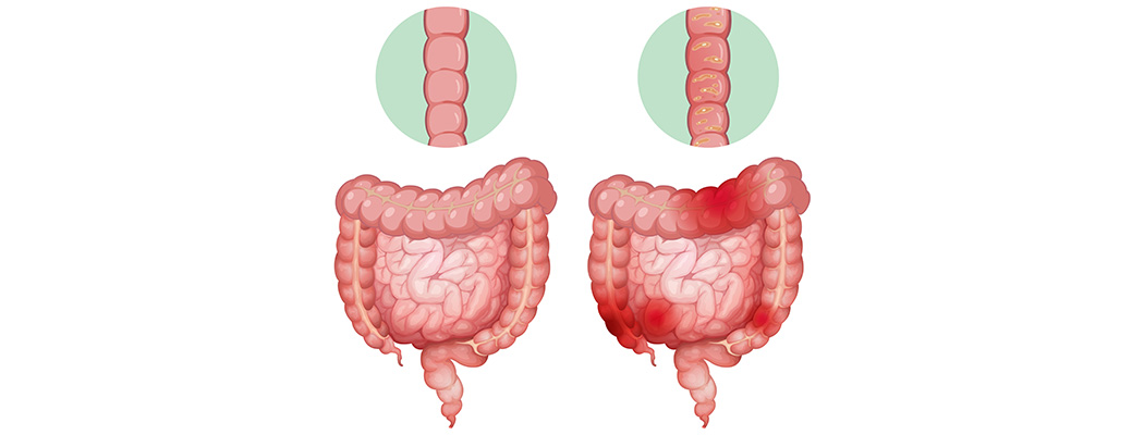 Top Reasons for Constipation and the Best Ways to Relieve It