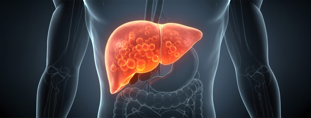 Illustration of fatty liver disease with fat accumulation