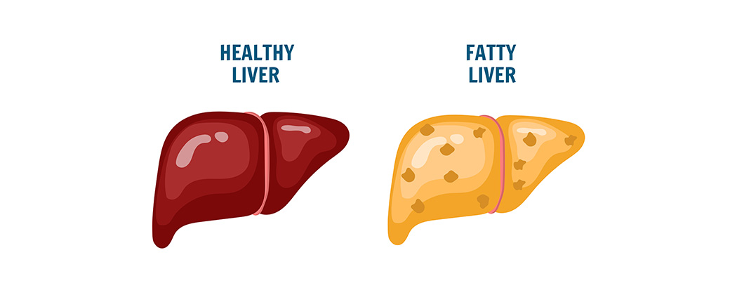 Comparison of a healthy liver and a fatty liver