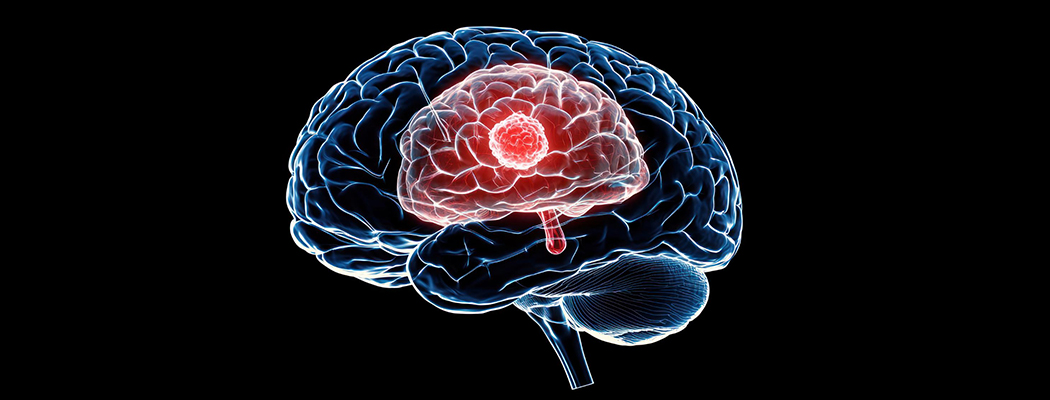 Brain Tumour Types Explained Simply 