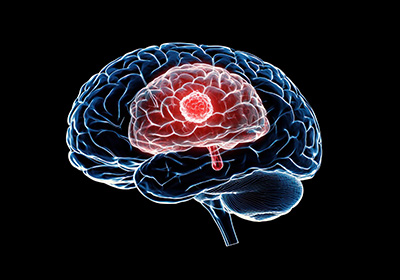 Brain Tumour Types Explained Simply 