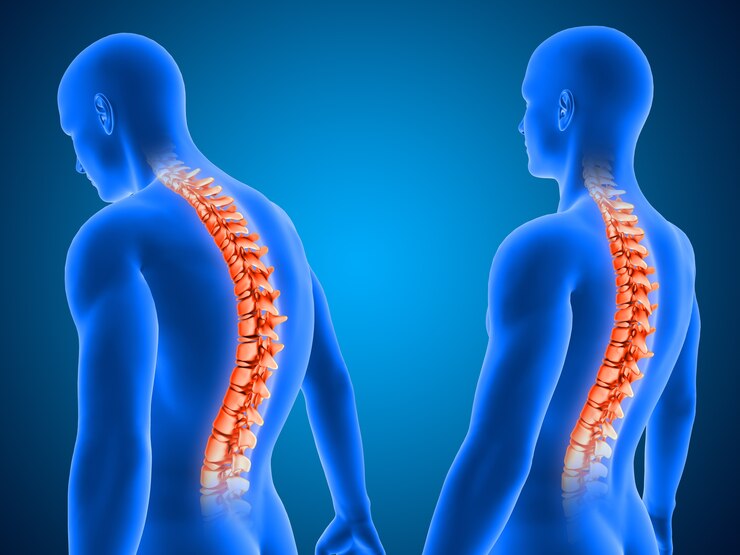 poor posture from slip disc