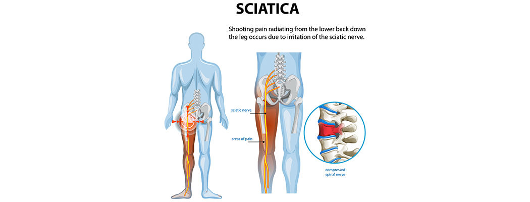 Sciatica Caused by Herniated Disc: When to See a Specialist 