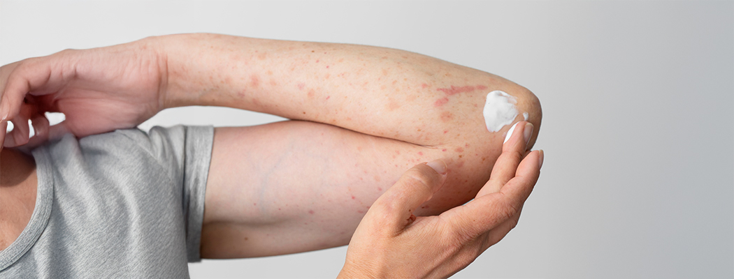 Fungal Infections: Symptoms & Effective Treatment Options 