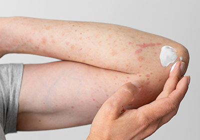 Fungal Infection Symptoms: When to Seek Medical Care