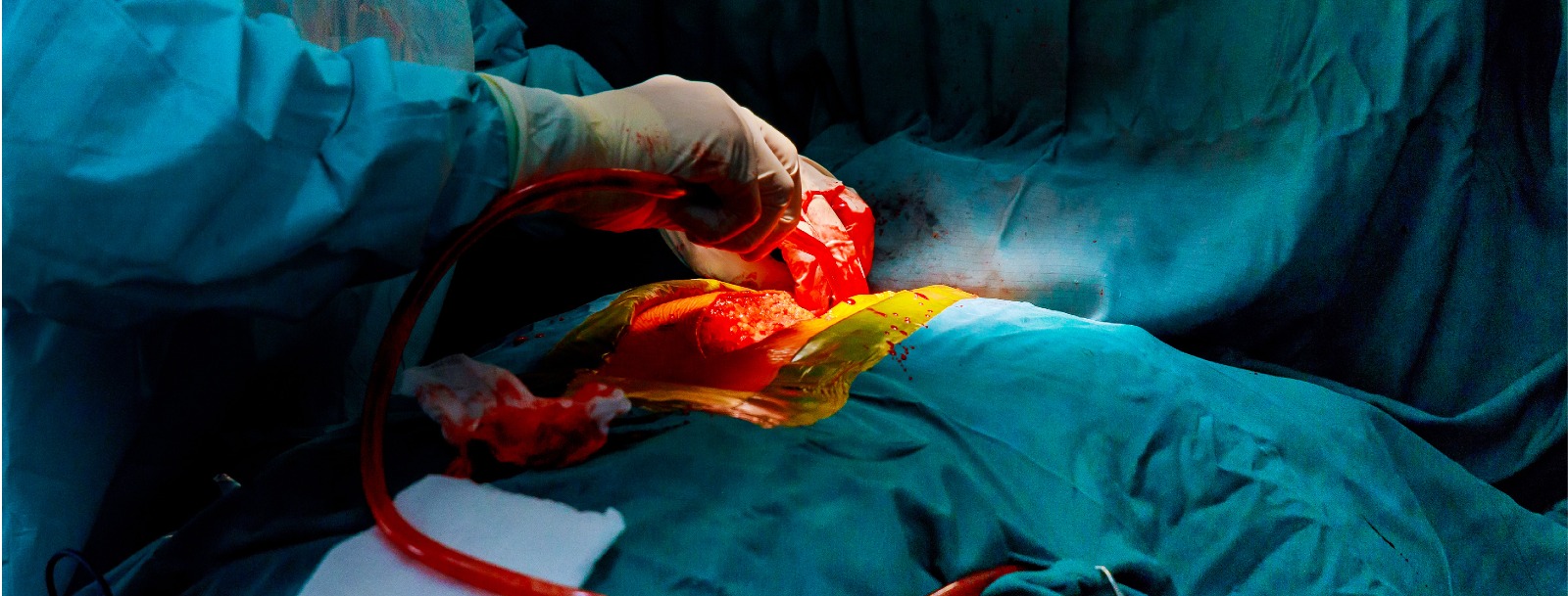 Bypass Surgery: Which Cardiac Diseases Require CABG? 