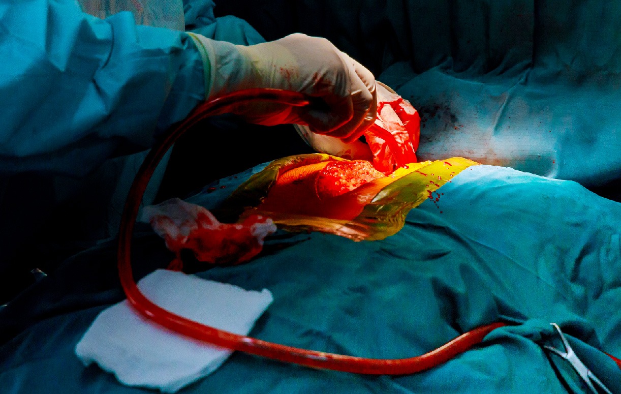 Bypass Surgery: Which Cardiac Diseases Require CABG? 