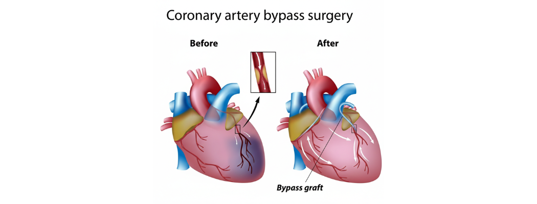 CABG for Heart Attack Patients: When Is It Urgent? 