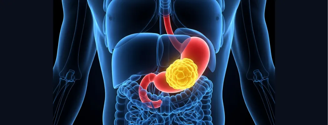 Medical illustration showing a stomach tumor in the digestive system