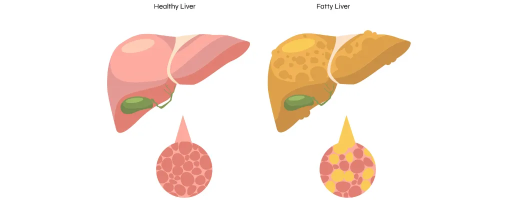 Healthy liver vs fatty liver illustration