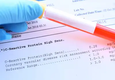 CRP Test & Heart Disease: What Your Inflammation Levels Reveal