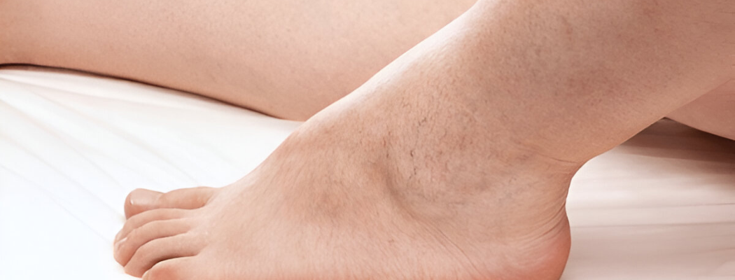 Close-up of a foot and ankle with visible spider vein
