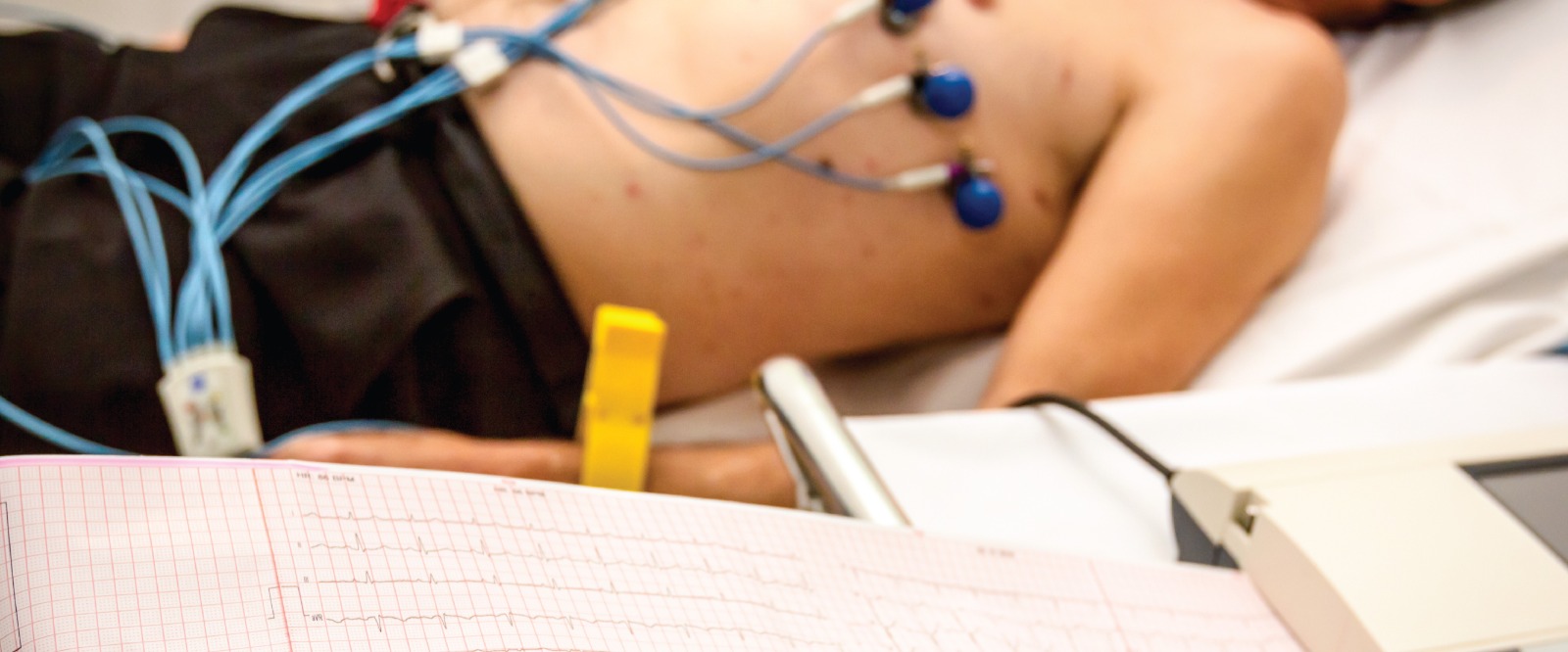 Everything You Want to Know About Arrhythmia