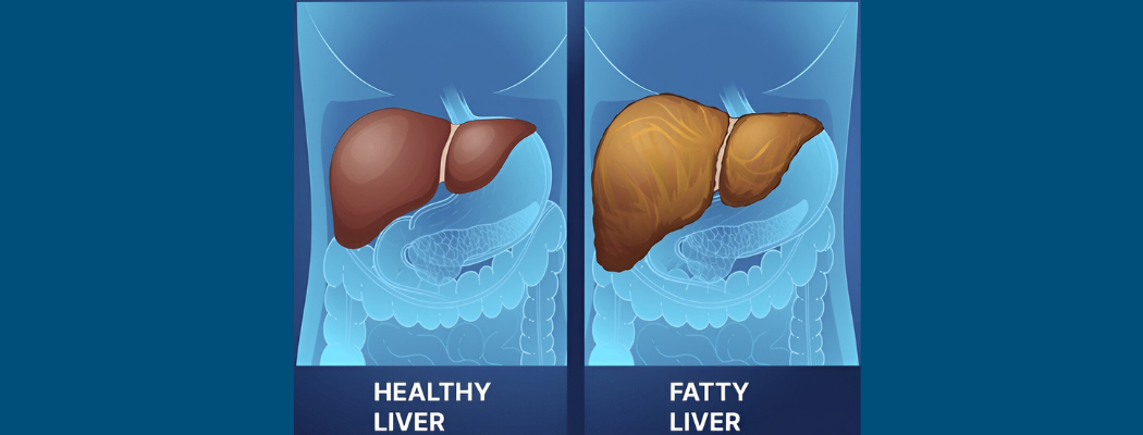 Illustration comparing healthy and fatty liver