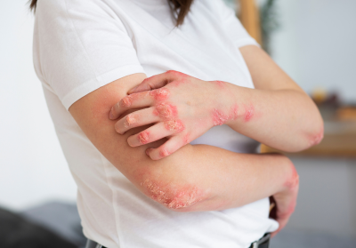 Preventing Fungal Infections: Tips and Hygiene Practices 