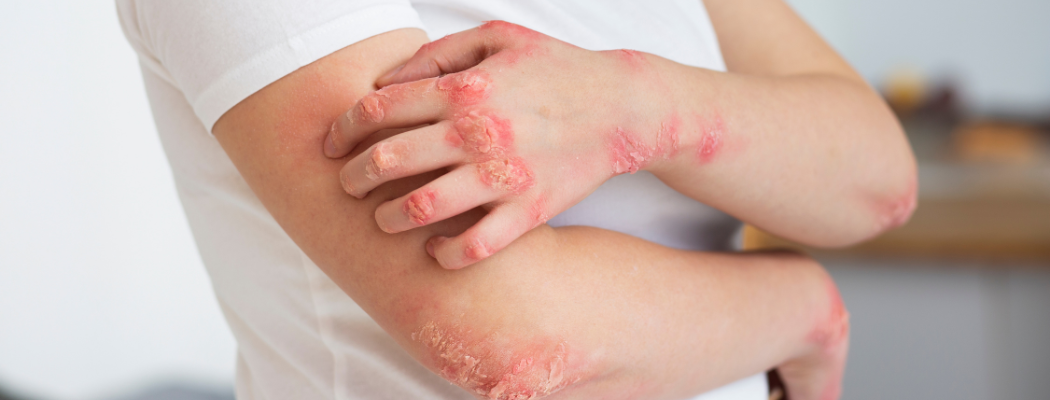 Preventing Fungal Infections: Tips and Hygiene Practices 