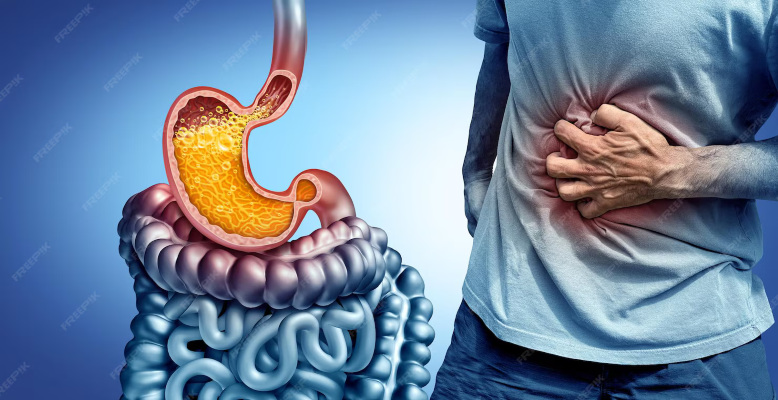 GERD vs. Hyperacidity: Know the Difference and How to Manage Both