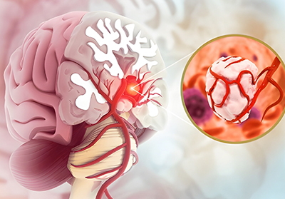 Understanding Brain Tumours: Types, Signs and Treatment Options