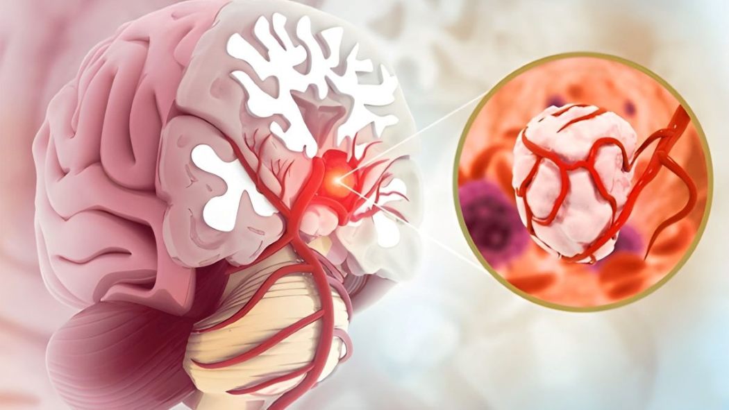 Illustration of brain showing tumor with blocked blood vessel