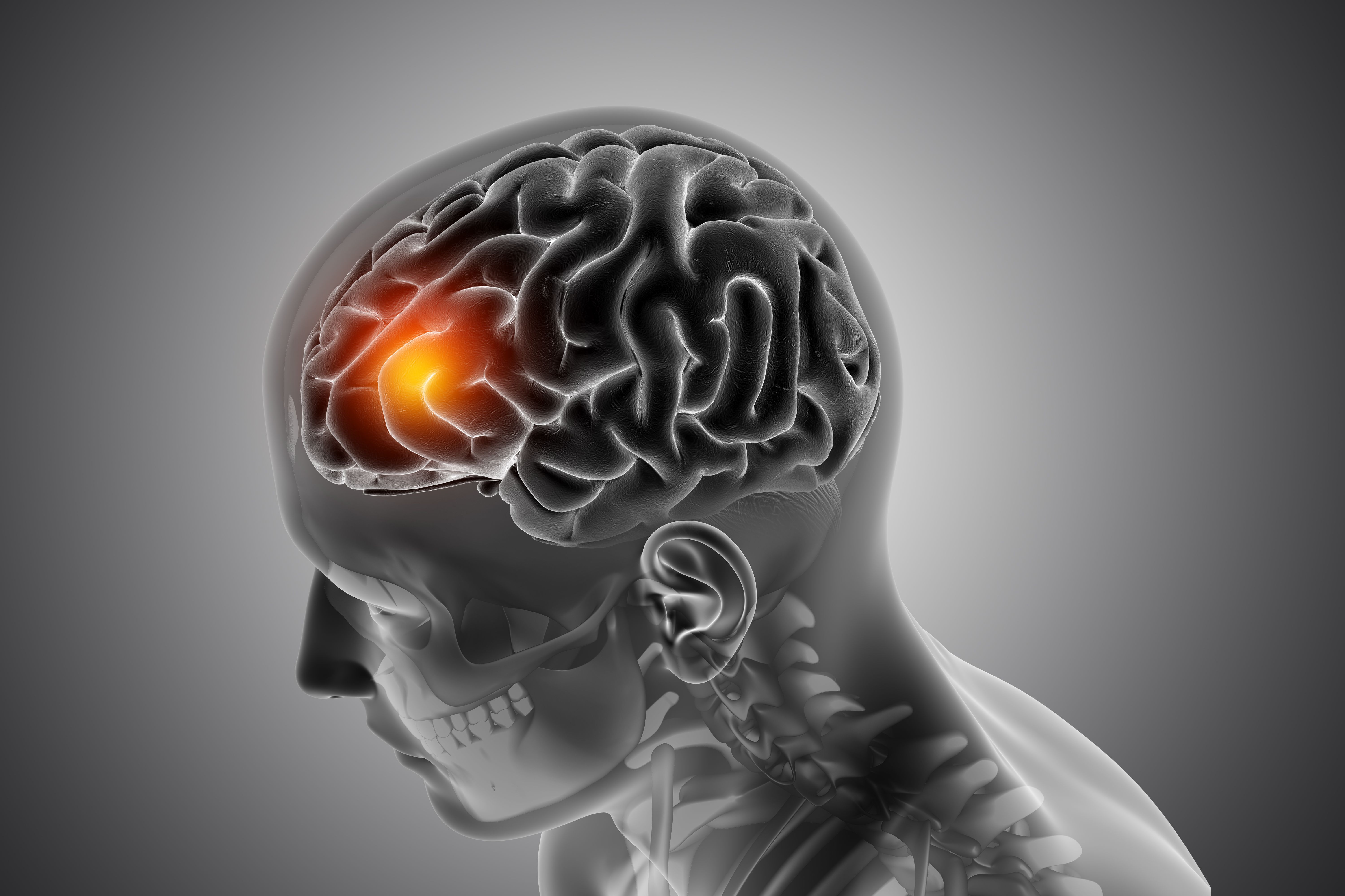 Stroke - The Silent Brain Attack 
