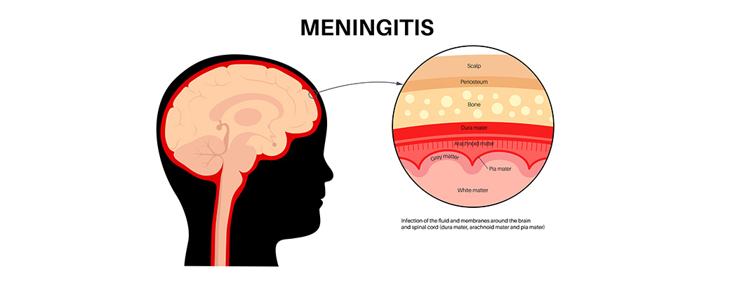 Meningitis: Causes, Symptoms, Diagnosis & Treatment