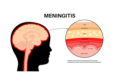 Meningitis: Causes, Symptoms, Diagnosis & Treatment
