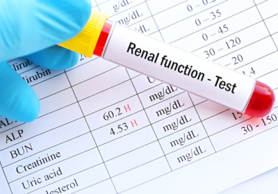 How to Reduce High Creatinine Levels Naturally?
