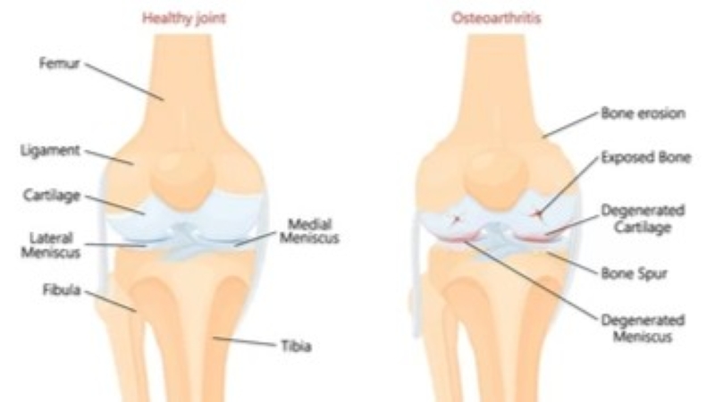 Understanding Osteoarthritis: From early signs to advanced treatment solutions in 2025