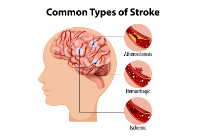 Lifestyle, Prevention & Awareness: Daily Habits to Reduce Your Stroke Risk