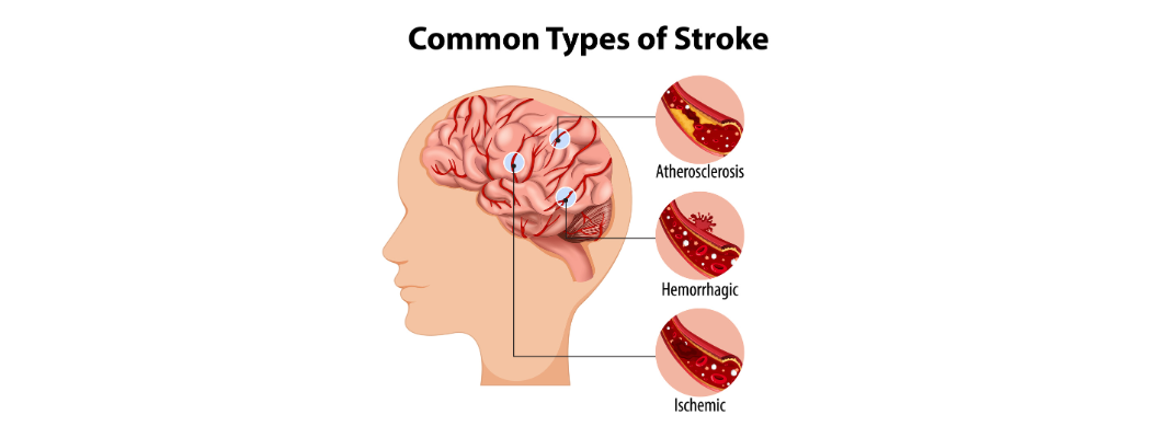 Lifestyle, Prevention & Awareness: Daily Habits to Reduce Your Stroke Risk