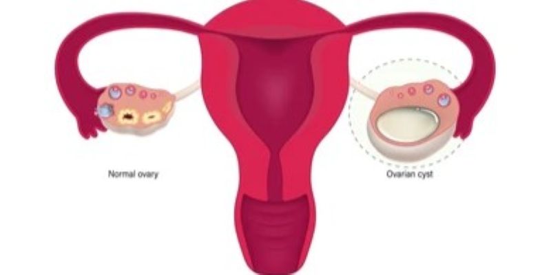 Ovarian Cyst – What’s Normal, Red Flags and Care