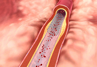 Types of Stents: What They Are, How They Work, and Which One Is Right for You