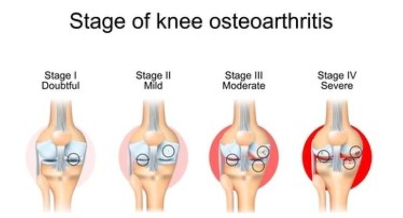 Early Signs of Osteoarthritis You Shouldn’t Ignore